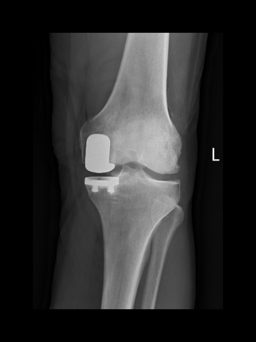 Postoperative X-ray showing a medial partial knee replacement