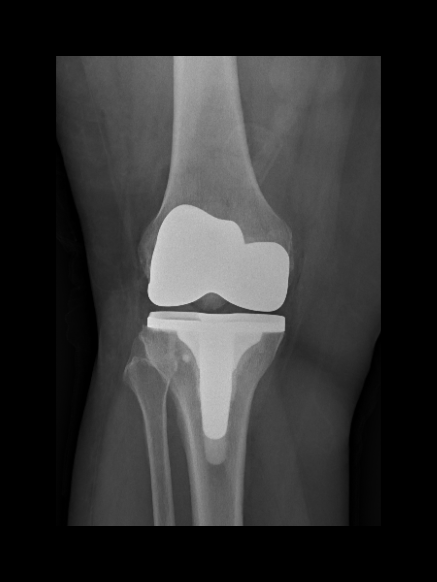 Postoperative X-ray showing a total knee replacement